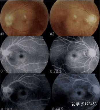 最新藥肺炎詳解，你需要知道的一切——健康小紅書